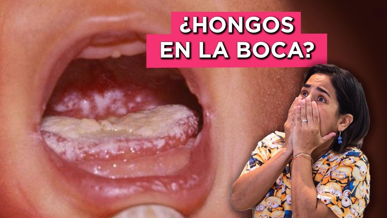 hongos en la boca del bebé fotos